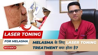 Laser toning treatment for Melasma  Best Treatment for Melasma  Laser Treatment for Melasma [upl. by Neroled598]