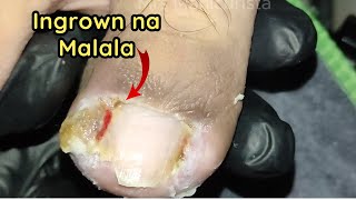 Toenail Ingrown Removal Grabi Malalang Ingrown na to [upl. by Alcinia]