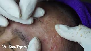 Acne Blackheads Whiteheads removals on face part 16  How to get rid of blackheads easy [upl. by Timothee195]