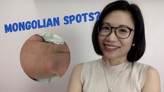 What are Mongolian Spots in Newborns Should you be worried  Dr Kristine Kiat [upl. by Brodsky]