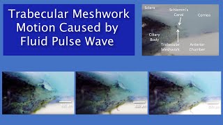 Trabecular Meshwork Pulseinduced Motion Video [upl. by Toshiko]