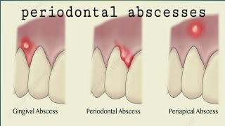 periodontal abcsess 2 peridontic abscess gingiva [upl. by Elconin999]