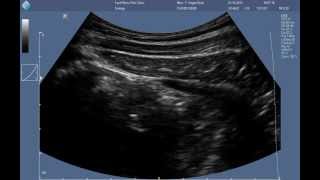 Abdominal RUSI ultrasound  correct contraction of the transversus abdominis [upl. by Norehs]