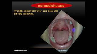 herpangina oral medicine طريقة التشخيص والعلاج [upl. by Aisanahta]