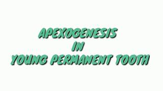 apexificationapexogenesis atozkidsdental APEXOGENESISAPEXOGENESIS IN YOUNG PERMANENT TOOTH [upl. by Lindie]