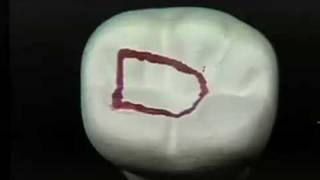 Endodontic Cavity Preparation  Phase I  Posterior [upl. by Nileuqay]