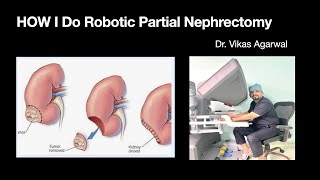 Robotic Partial nephrectomy for left lower pole kidney tumor [upl. by Eneirda900]