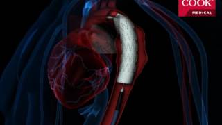 Thoracic Endovascular Aortic Repair TEVAR [upl. by Dotty]