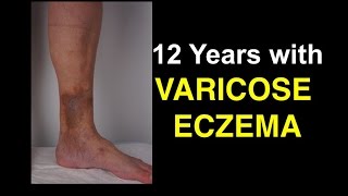 12 Years With Varicose Eczema  Shocking Lessons [upl. by Allianora488]