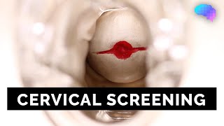 Cervical Screening SMEAR  OSCE Guide  UKMLA  CPSA [upl. by Elmira]