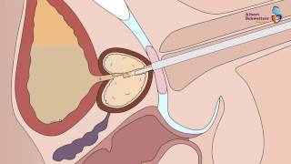 TUR PROSTAAT Het verwijderen van prostaatweefsel bij plasproblemen [upl. by Sid863]