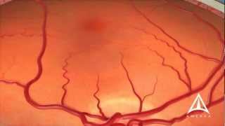 Dry Macular Degeneration [upl. by Ybot]