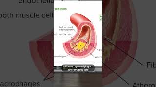 What is Atherosclerosis  Lecturio [upl. by Foley]