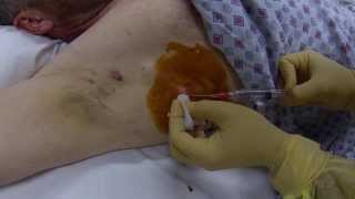 infected cyst drainage procedure [upl. by Ihpen]