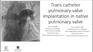 Trans catheter pulmonary valve implantation in native pulmonary valve [upl. by Darcee]