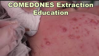 Comedones Extraction Part 1 of the best acne treatment before and after pictures included [upl. by Southard]