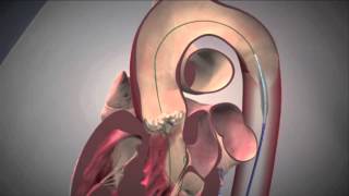 Edwards SAPIEN Transcatheter Aortic Valve Replacement [upl. by Yrelle914]