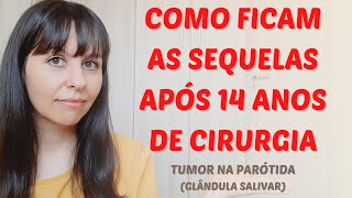 Como ficam as sequelas após 14 anos de cirurgia do tumor na parótida [upl. by Kieryt798]