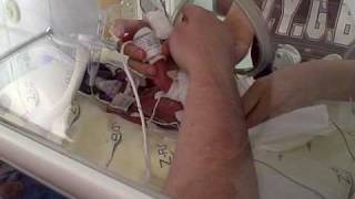 24 week preemie Avens first diaper change [upl. by Annairam500]