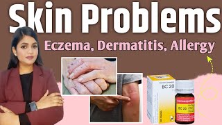 skin problems homeopathic medicine  Eczema dermatitis rashes fungal infection allergy treatment [upl. by Aneehsar889]