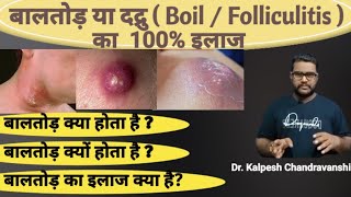 बालतोड़  फोड़ा नासूर का इलाज  How to treat boil at home  Treatment of boil in allopathy [upl. by Lavotsirc562]