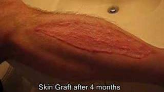 Part 4  Brads Surgery 4 months after graftb [upl. by Uzial562]