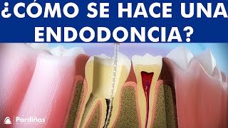 ¿Qué es una Endodoncia  Tratamiento de conductos o desvitalización del diente paso a paso © [upl. by Ermeena57]