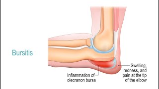 Treating Bursitis [upl. by Annayk895]