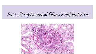 Post Streptococcal Glomerulonephritis PSGN [upl. by Ahcropal]