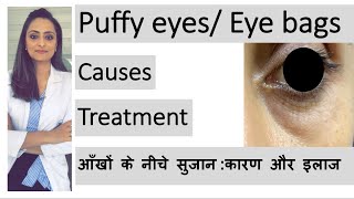 puffy eyes eye bags aankhon ke neeche sujan  कारण और इलाज  Dr Aanchal  dermatologist [upl. by Stanleigh]