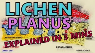 LICHEN PLANUS  EXPLAINED IN 3 MINUTES  ETIOLOGY SYMPTOMS TREATMENT [upl. by Esaele133]