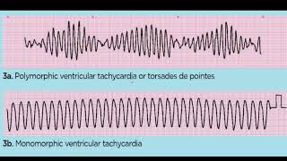 TORSADES DE POINTES 4TH YR [upl. by Lemhar]