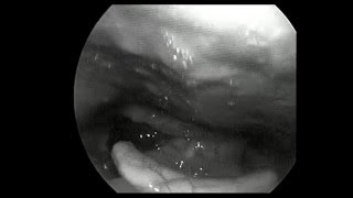 Video laryngoscopy showing Intra Epithelial Cell Carcinoma of Larynx [upl. by Hgielrahc]