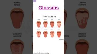 Glossitis Shortsvideo CPC Exam Medical Coding and Billing medicalcodercertified [upl. by Coster]