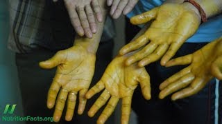 Topical Application of Turmeric Curcumin for Cancer [upl. by Nnael]