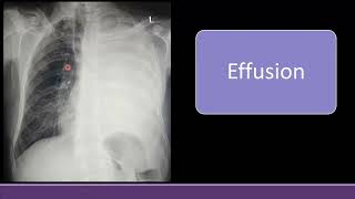 Chest Xray Findings in Pleural Effusion Consolidation Collapse White lung Field radiology [upl. by Toddie]