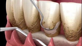 quotPeriodontal flap surgerystep by step “ [upl. by Even]