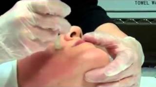 Dermapen Micro Needling Treatment [upl. by Aissila]