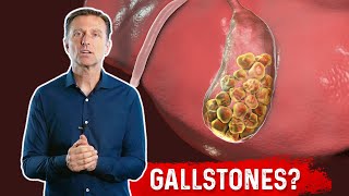 What is a Gallbladder Attack – Symptoms amp Causes Covered by DrBerg [upl. by Aylat815]