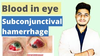 Subconjunctival Hemorrhage Treatment Causes Symptoms  आखों में लाली आना । Redness eye trearment [upl. by Clower]