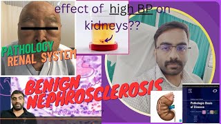 NEPHROSCLEROSISEFFECT OF HYPERTENSION ON KIDNEY PART 21  NEPHROLOGY [upl. by Wainwright]