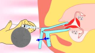 Intrauterine insemination IUI videoflv about infertility and ivf treatment [upl. by Ycniuqal]