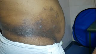 Tinea CorporisTreatment in tamil  படர் தாமரை  Dr Selvin Innocent Dhas [upl. by Yoo]