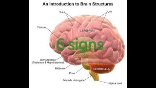 6 signs or symptoms of cerebral edema [upl. by Zeret122]