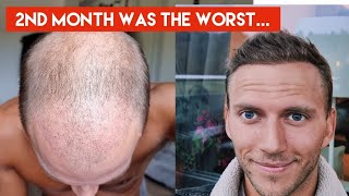 My Hair Transplant Journey  The AWFUL first 4 months indepth walkthrough week by week [upl. by Eicrad538]