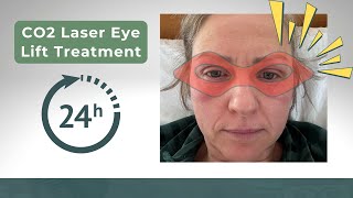 CO2 Laser Eye Lift Recovery DAY 1 Update [upl. by Oiralih446]