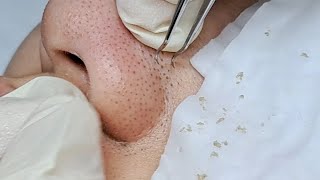 Satisfying Relaxing Skin Deep Clean  Halo Skin Hong Kong Acne and Blackheads 黑頭粉刺 Shorts [upl. by Ehcram]