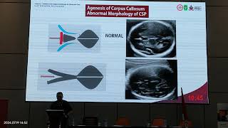 Video 2 Corpus Callosum Diagnosis [upl. by Llenaj]