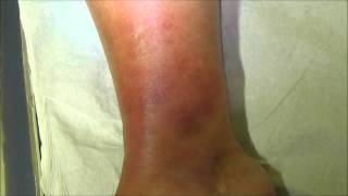 A case of tibial cellulitis before and 24 hours after treatment with antibiotics [upl. by Seda]