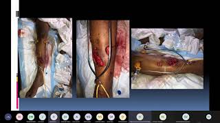 Plastiquest Case DiscussionMiddle 13rd Lower limb defect 2 [upl. by Tybalt]